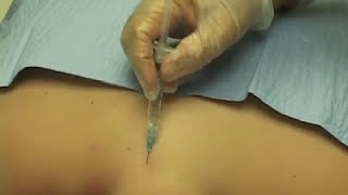 Cervical-Epidural-Nerve-Block-Image