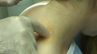 Trigger-Point-Block-Image