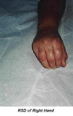 db_Hand_Deformity_Pic_-1_copy1