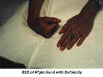db_Hand_Deformity_Pic_-2_copy1