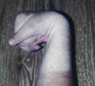 db_Hand_Deformity_Pic_-4_copy1