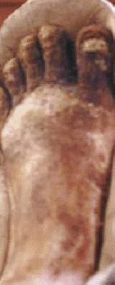 db_Left_Foot_Deformity_Pic_-5_copy1