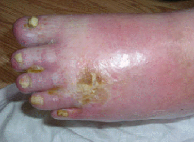 db_RSD_Infection_Pic_-2_copy1