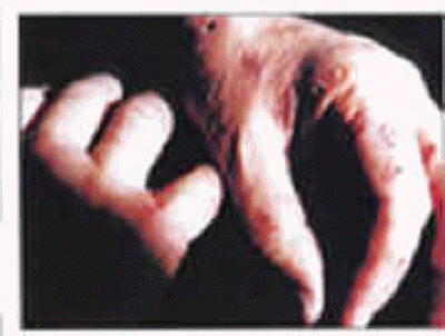 db_VP_Lesions_afterTreatment_copy1