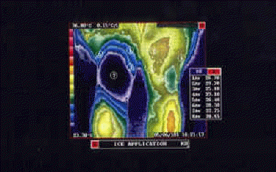 Cryotherapy Thermography