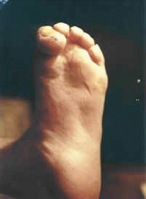 Left Foot Deformity Picture #2 