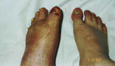 Left Foot Deformity Picture #7 