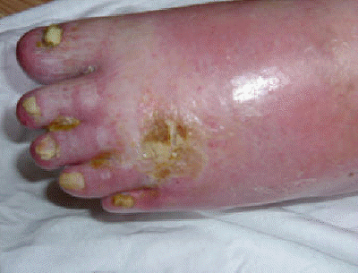 RSD Infection Picture #1