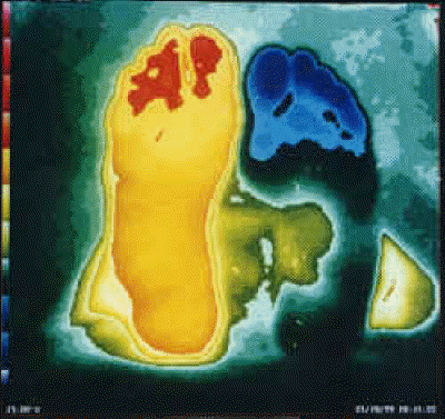 RSD Neuroma Exploration Thermography.