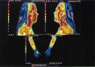 Thermography Picture #3 