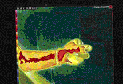 Venipuncture CRPS II Thermography